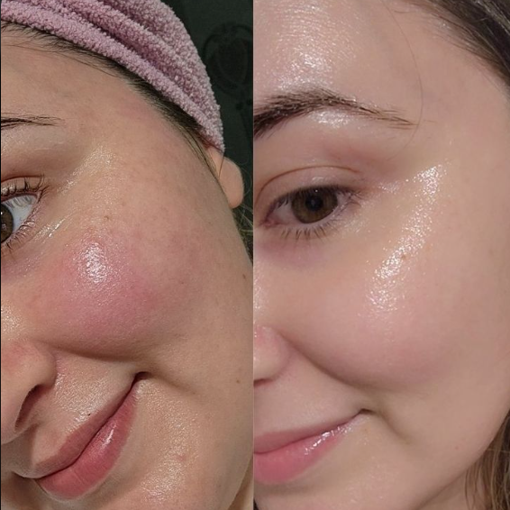 skin brightening facial Patna