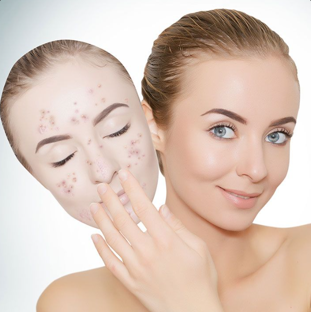 pimple treatment Patna