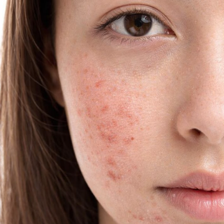 uneven skin tone treatment