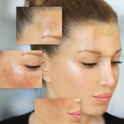 Acne treatment in patna