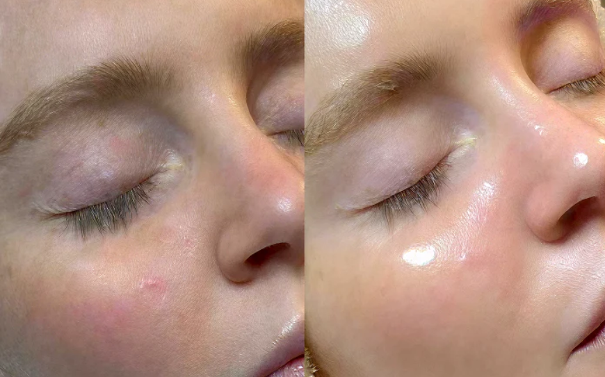 facial glow treatment Patna